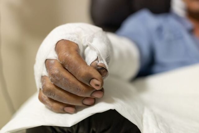 burn injuries3 burn injuries